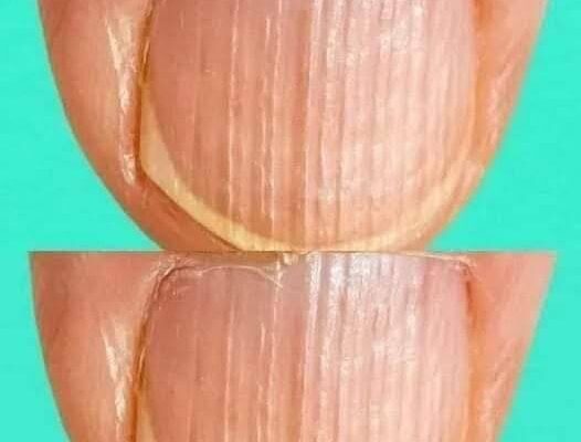Rippled fingernails reveal secrets of possible disease.